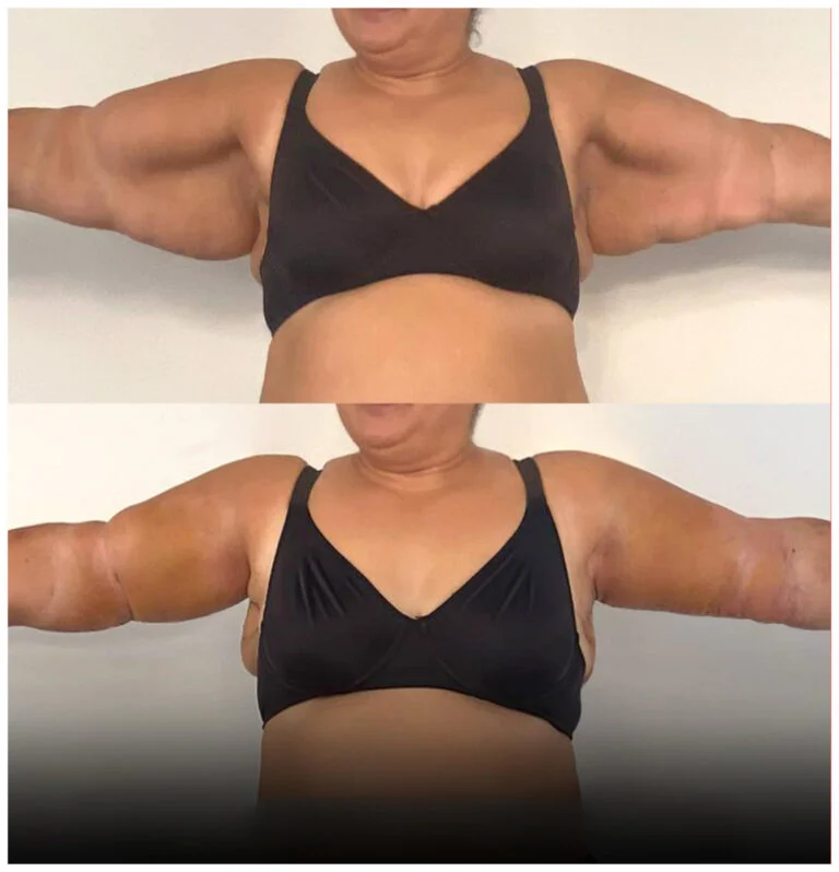Before and after photos of an arm lift procedure, showing the reduction of excess skin and fat from the upper arms.