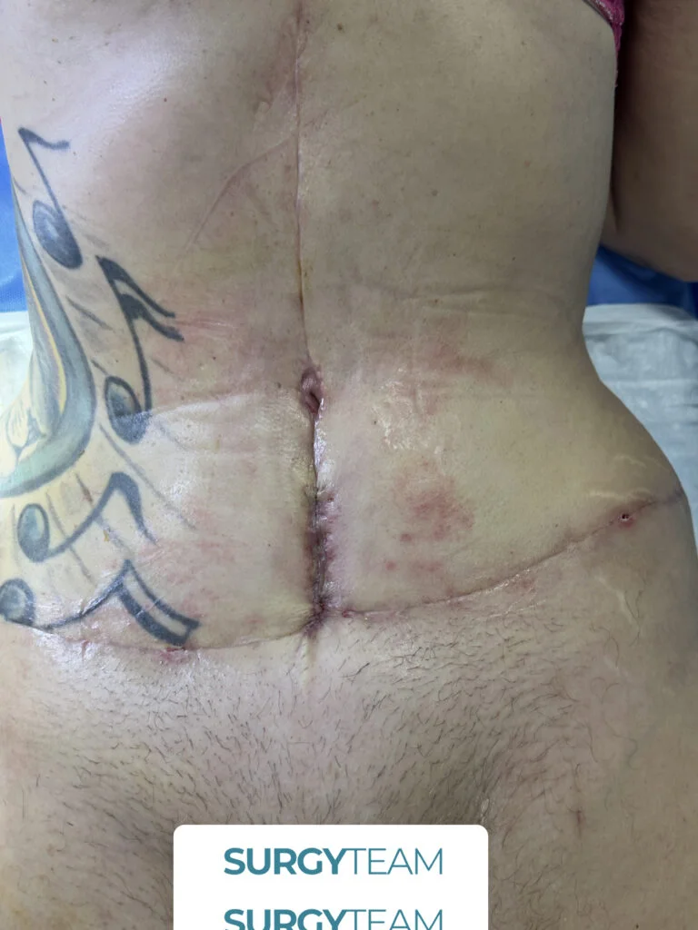 A person with visible tattoos and multiple surgical scars on their back and side, likely indicating a history of surgical procedures. The image is associated with SurgyTeam.