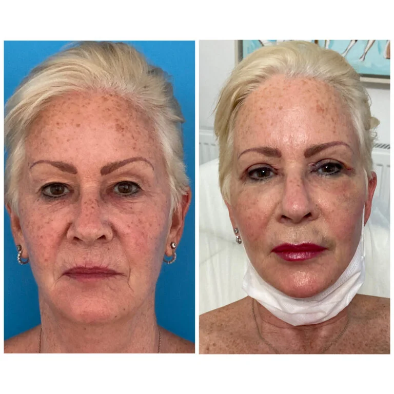 Before and after comparison photo of a woman's face. The left image shows her face before the procedure with visible signs of aging. The right image shows her face after the procedure, looking more youthful and rejuvenated.