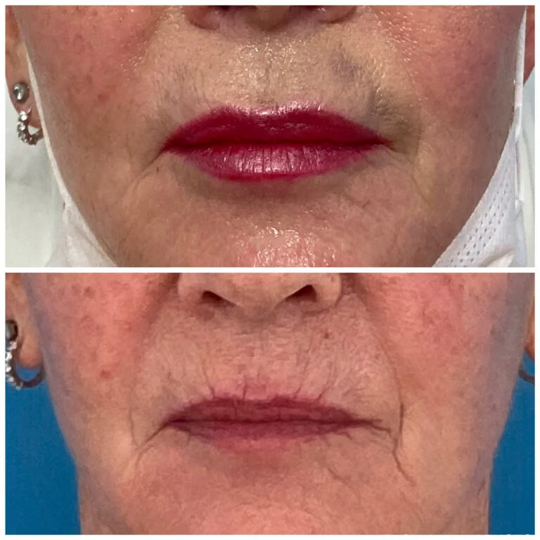 Before and after comparison of a lip augmentation procedure, showing the lips with and without lipstick.