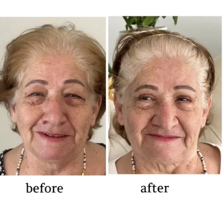 A before-and-after comparison of an elderly woman's face. The 'before' image shows her with visible wrinkles and age spots, while the 'after' image shows her with smoother skin and reduced age spots, likely due to a cosmetic procedure.