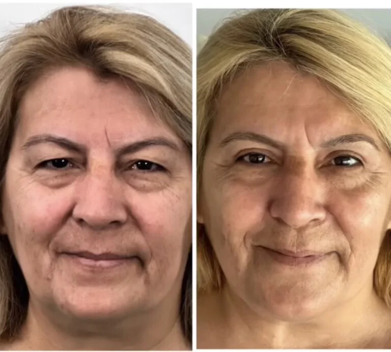 Before and after photo of a woman who has undergone facial cosmetic surgery, showing noticeable improvements in facial features and skin texture.