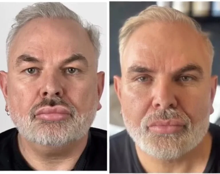 A before-and-after comparison of a man's face, showcasing changes in his facial features.