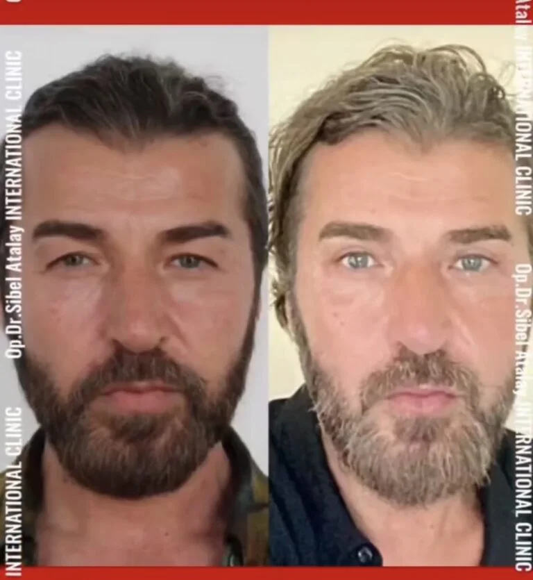 Before and after comparison photo of a man with beard and mustache, showing results of a procedure at an international clinic.