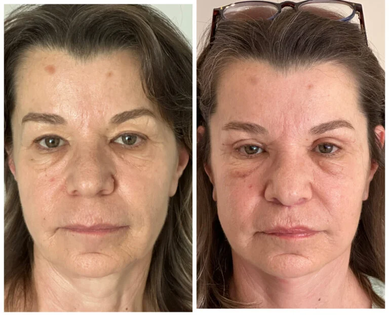Before and after comparison of a woman's face, likely showcasing the results of a cosmetic procedure or treatment.