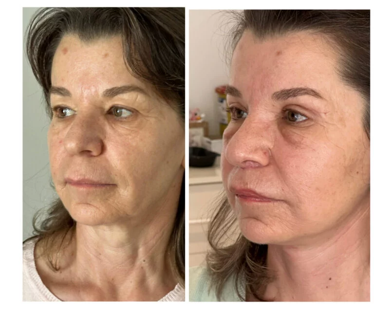 Before and after comparison photos of a person's face, highlighting changes in facial features and skin condition.