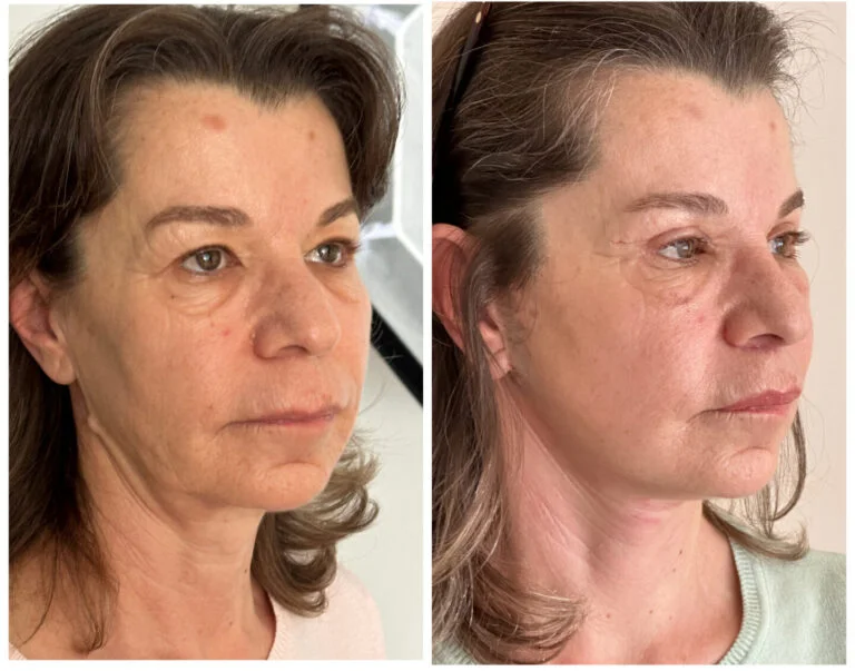 Before and after comparison photo of a woman's face showing the results of a cosmetic procedure. The left side shows the woman's face before the procedure, while the right side shows her face after the procedure, highlighting the changes in her appearance.