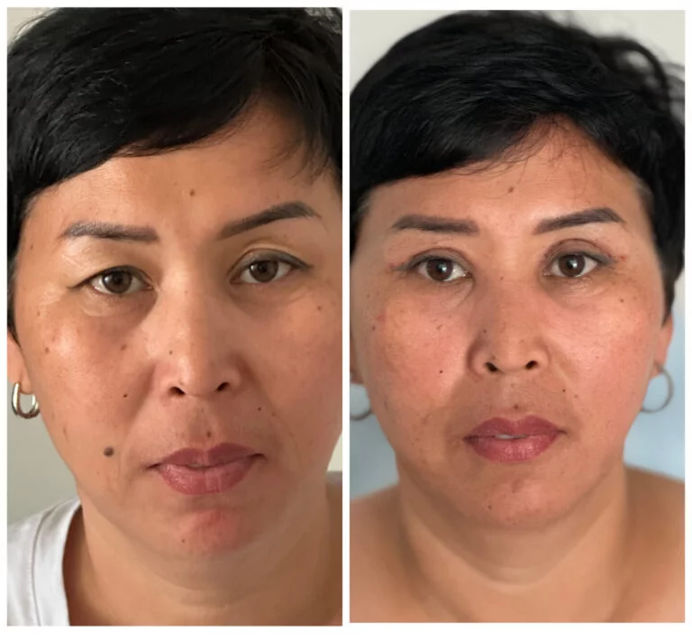 Before and after comparison photos of a person's face, likely showcasing the results of a medical procedure or treatment.
