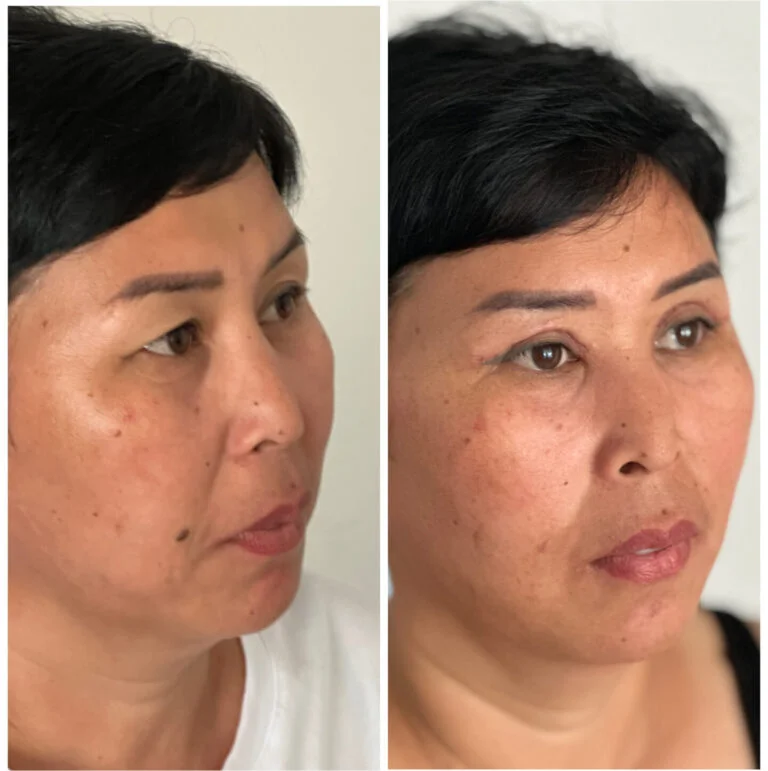 Before and after comparison of a woman's face, likely showcasing a medical procedure or treatment.