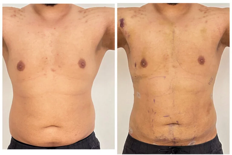 Before and after comparison of a person's torso, highlighting changes in the abdominal area, likely due to a surgical procedure or significant weight loss.