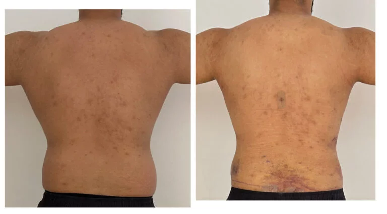 The back of a person with visible skin conditions, including hyperpigmentation and possibly scars or lesions.