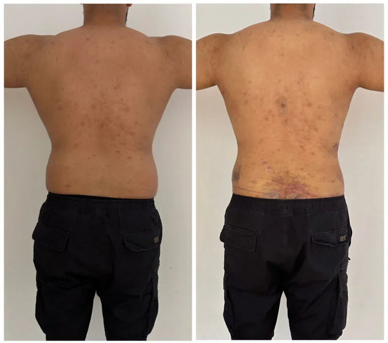 The image shows the back of a person with visible skin conditions, likely acne or a similar dermatological issue, across the upper back and shoulder area. There is also a noticeable mark or scar on the lower back.