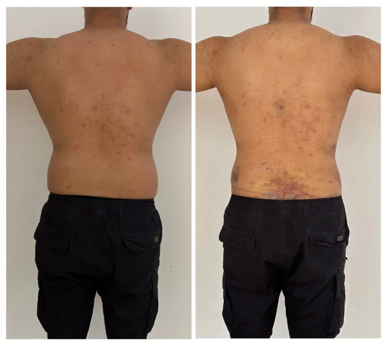 A man with acne on his back and a tattoo on his lower back is shown from the back in two different images. He is wearing dark pants and there is a white wall in the background.