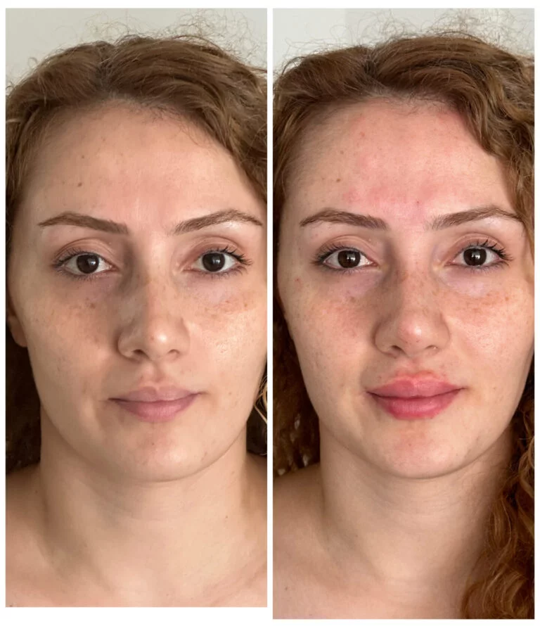 Before and after comparison of a young woman's face, highlighting changes in her skin condition.