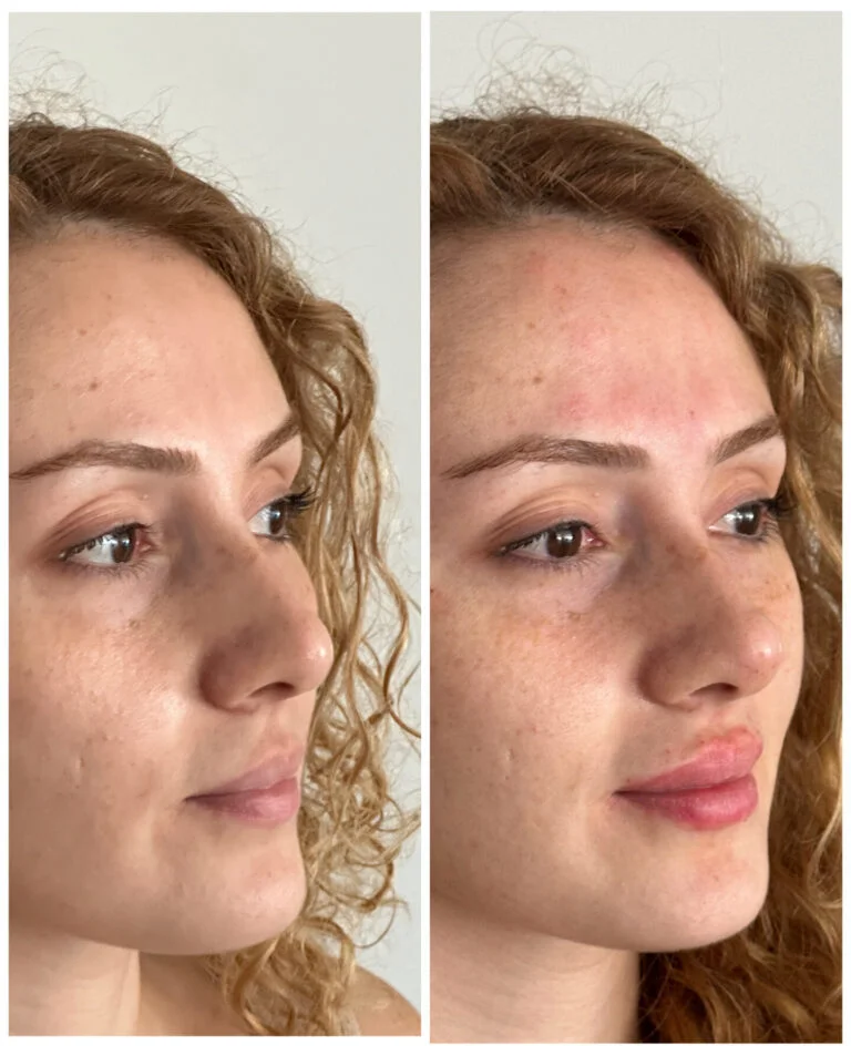 A before-and-after comparison of a woman's face, highlighting changes in her skin condition. The left image shows her with clearer skin, while the right image shows her with visible acne and redness.