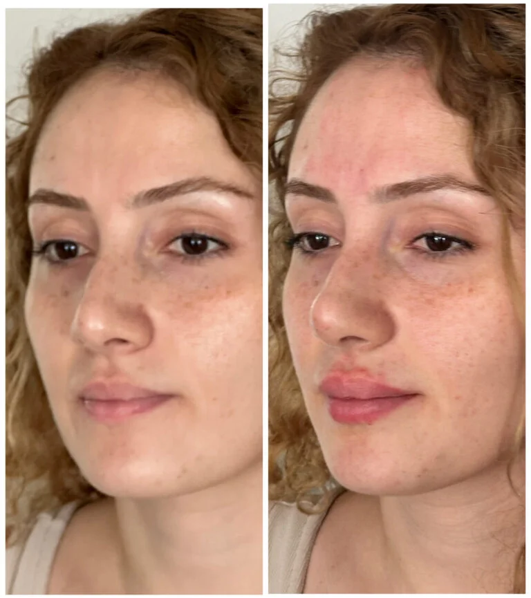 Before and after comparison photos of a woman's face focusing on her skin condition.