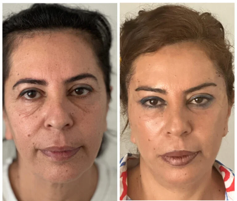 Before and after comparison of a woman's face, showcasing the results of a cosmetic procedure or makeup. The left side shows the woman with a natural look, while the right side displays her with makeup applied, enhancing her features.