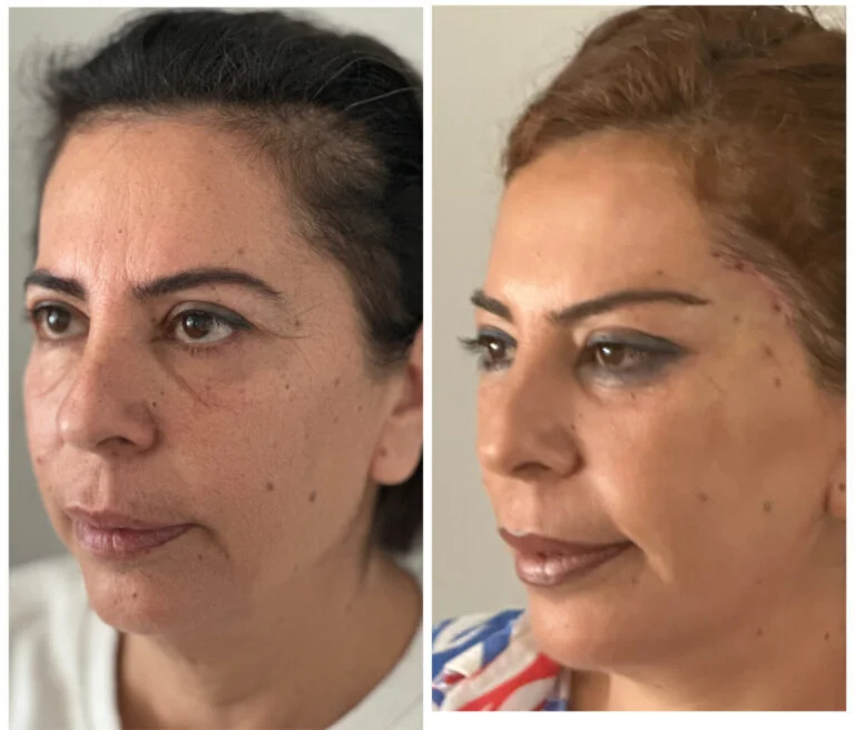 Before and after comparison of a woman's face, highlighting the changes in her skin and appearance.