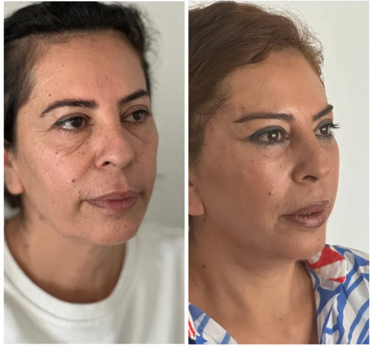 Before and after comparison of a woman's face, showcasing the results of a cosmetic procedure or treatment.