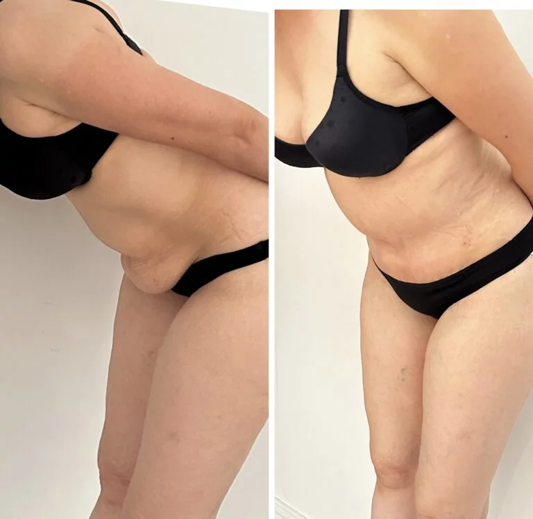 Before and after comparison of a person's side profile showing changes in appearance, likely due to a medical procedure or treatment.