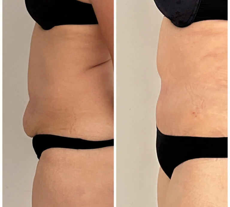 Before and after comparison of a person's abdomen, highlighting changes in skin texture and appearance, likely due to a medical procedure.
