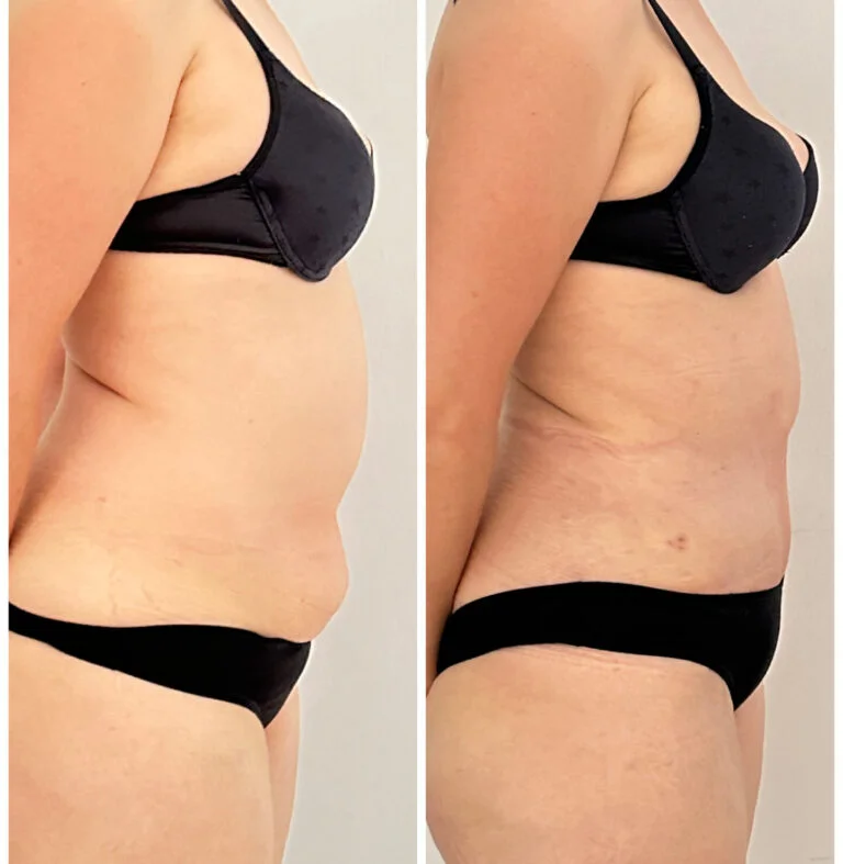 Before and after comparison of a woman's torso showing the results of a cosmetic procedure, likely a tummy tuck, with noticeable changes in skin tightness and contour.
