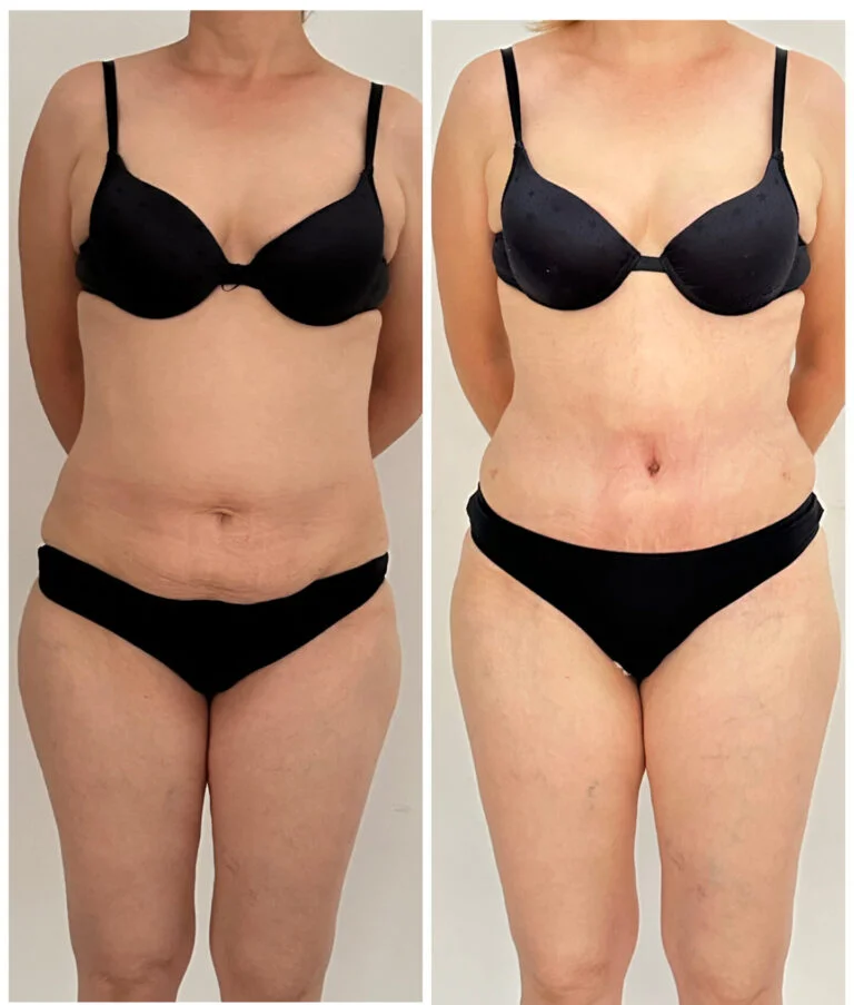 Before and after comparison of a woman's torso showing the results of a cosmetic procedure, likely a tummy tuck, with noticeable changes in the abdominal area.