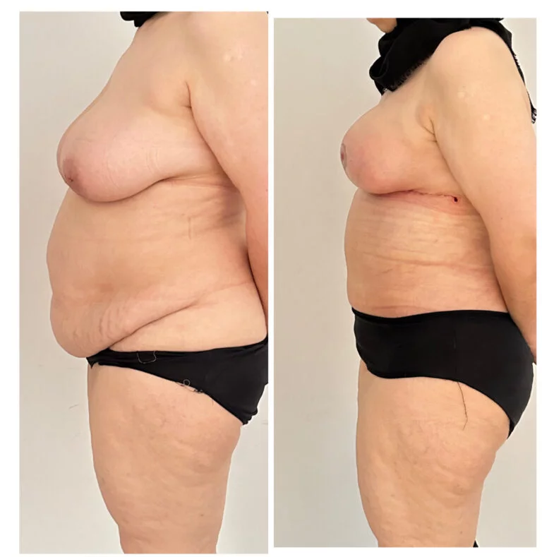 Before and after comparison of a person's side profile showing the results of a tummy tuck procedure.