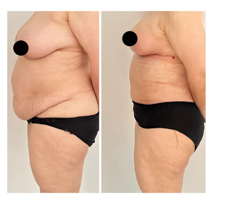 Before and after comparison of a person's side profile showing changes in body contour, likely from a surgical procedure.