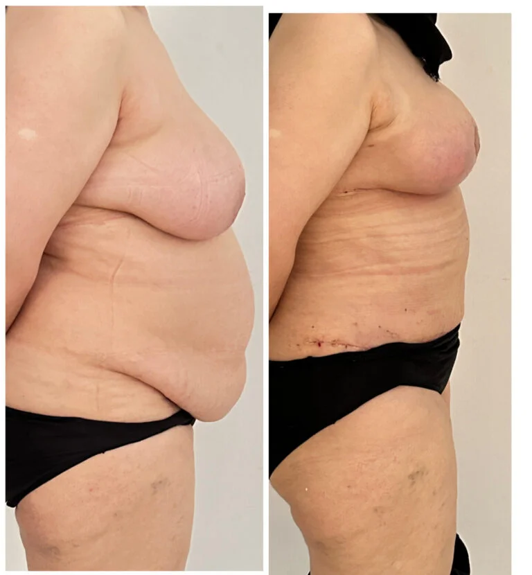 Before and after comparison of a woman's torso, highlighting changes in breast and abdominal appearance following a surgical procedure. The 'before' image on the left shows a woman with larger breasts and a more pronounced belly. The 'after' image on the right displays the same woman with smaller breasts, a flatter abdomen, and visible scarring from the surgery.