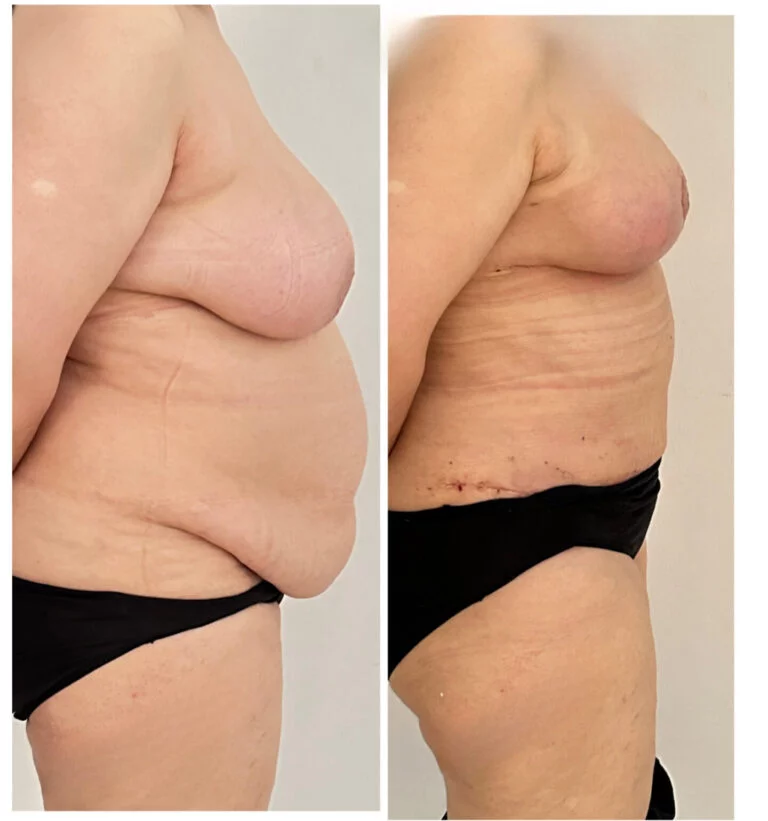 Before and after comparison of a person's side profile showing changes in appearance, likely from a medical procedure or weight loss.