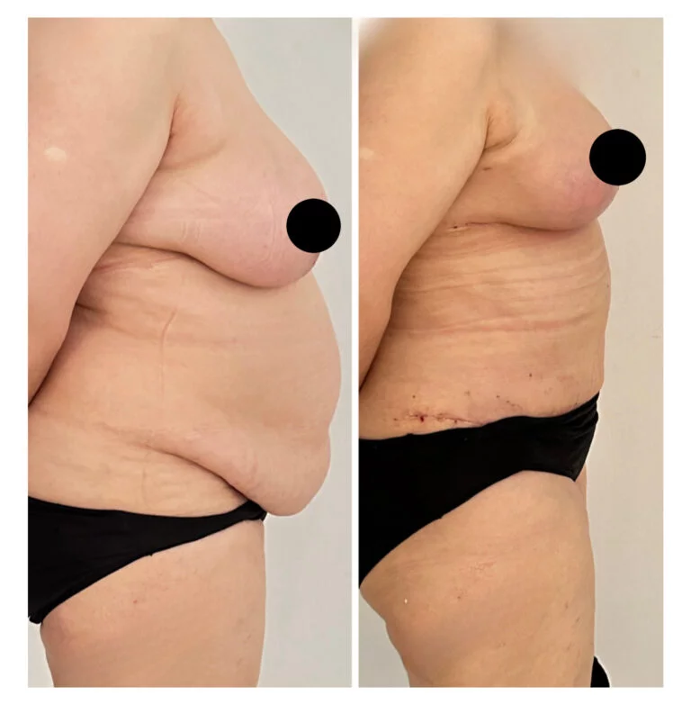 Before and after comparison of a person's side profile showing a noticeable difference in body contour, likely due to a surgical procedure. The image highlights changes in skin texture and appearance.