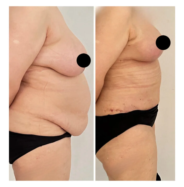 Before and after photos of a person's side profile showing breast reduction surgery results. The left image shows the breast before surgery, while the right image shows the breast after surgery with noticeable reduction and improved contour.