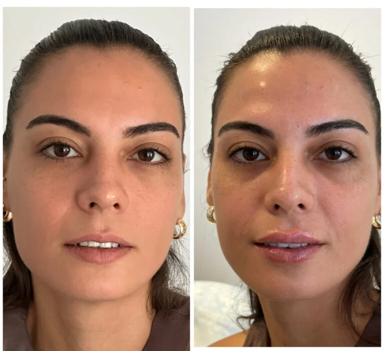 Before and after comparison of a woman's face, highlighting changes in her appearance.