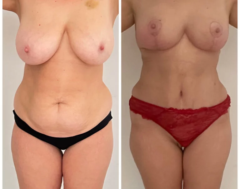 Before and after photos of a woman's torso, highlighting the results of a cosmetic surgical procedure. The 'before' image shows the woman with loose skin and stretch marks on her abdomen, while the 'after' image displays a firmer, smoother abdomen following the procedure.