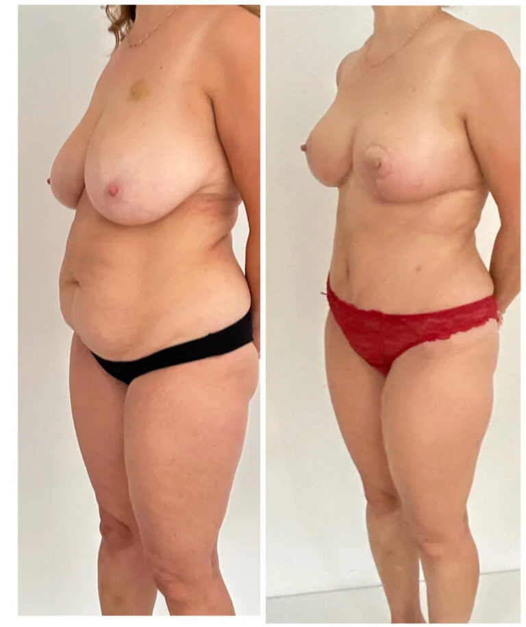 Before and after photo of a woman's body showing the results of a breast lift and tummy tuck procedure. The 'before' image on the left shows sagging breasts and excess skin on the abdomen. The 'after' image on the right shows lifted breasts and a tighter, more toned midsection following the surgeries.