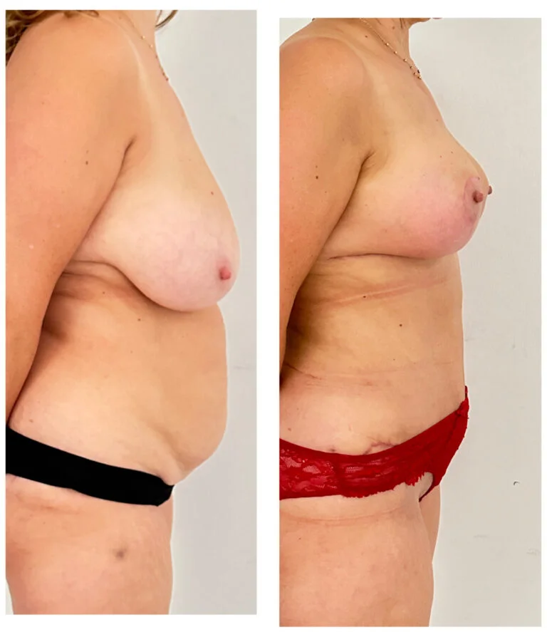 Before and after photos of a woman's body from the side, highlighting changes in her midsection and breasts. The 'before' image on the left shows a woman with a larger stomach and smaller breasts, while the 'after' image on the right shows a woman with a flatter stomach and larger, lifted breasts.