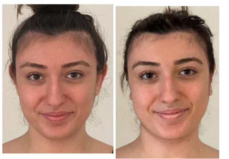 A before-and-after comparison of a young woman's face, showing her smile and facial features from the front.