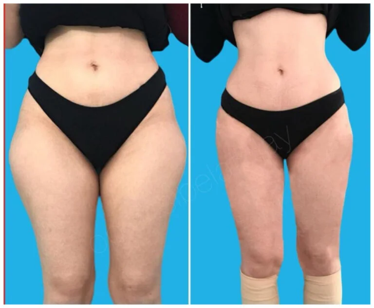 Before and after photo of a person's lower body showing the results of a cosmetic procedure.