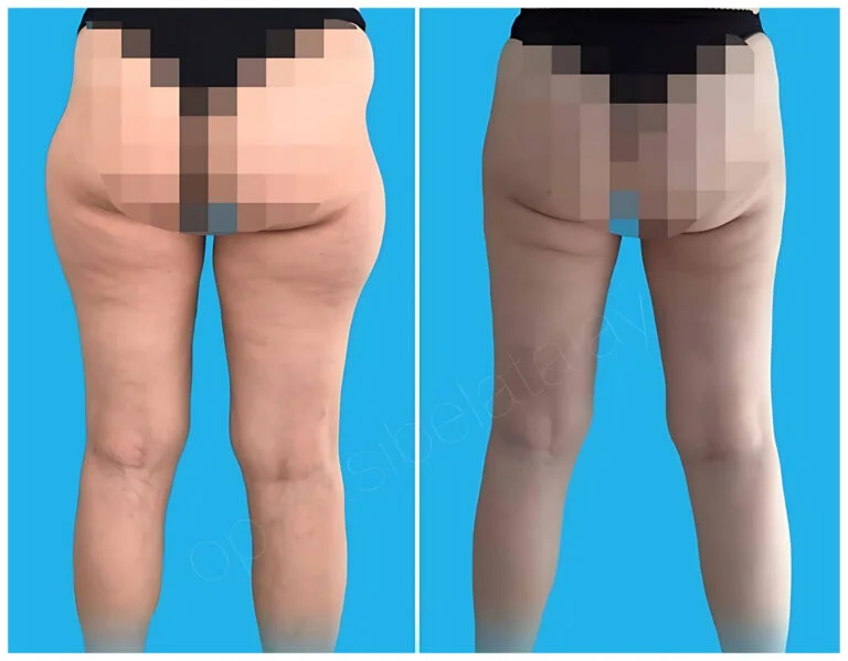 A before-and-after comparison of a medical procedure on legs, showing results against a blue background.