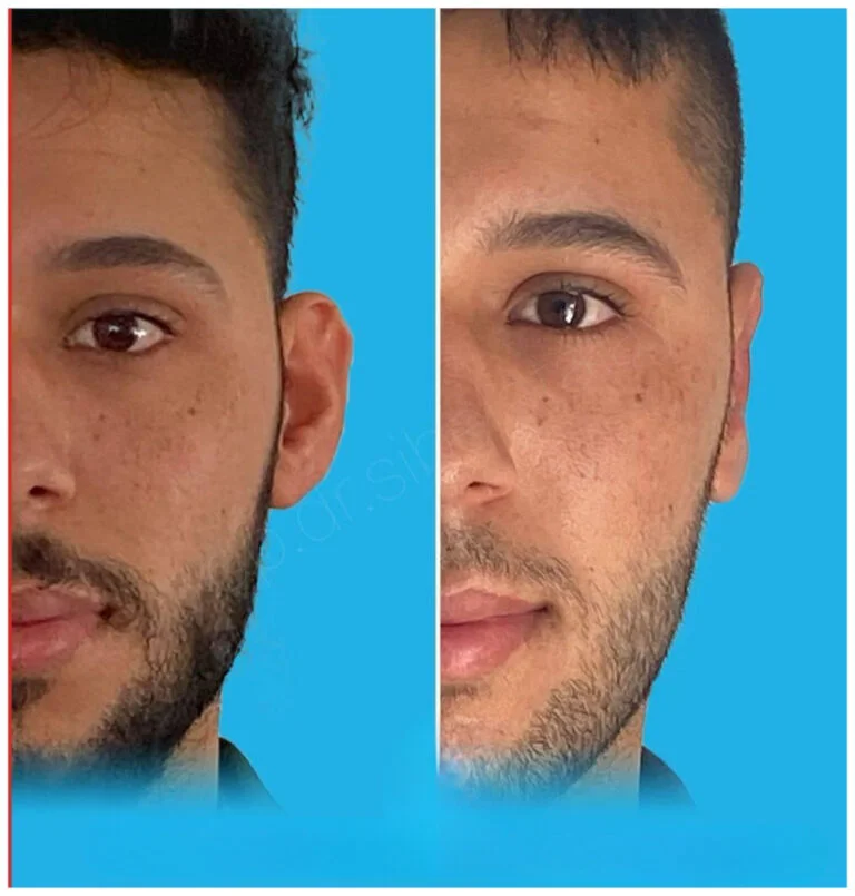 Before and after comparison photos of a man's face focusing on his eye and nose area, set against a blue background.
