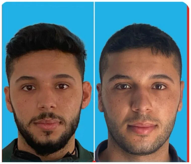 A side-by-side comparison of a person's face before and after a procedure, showing noticeable changes in facial features.