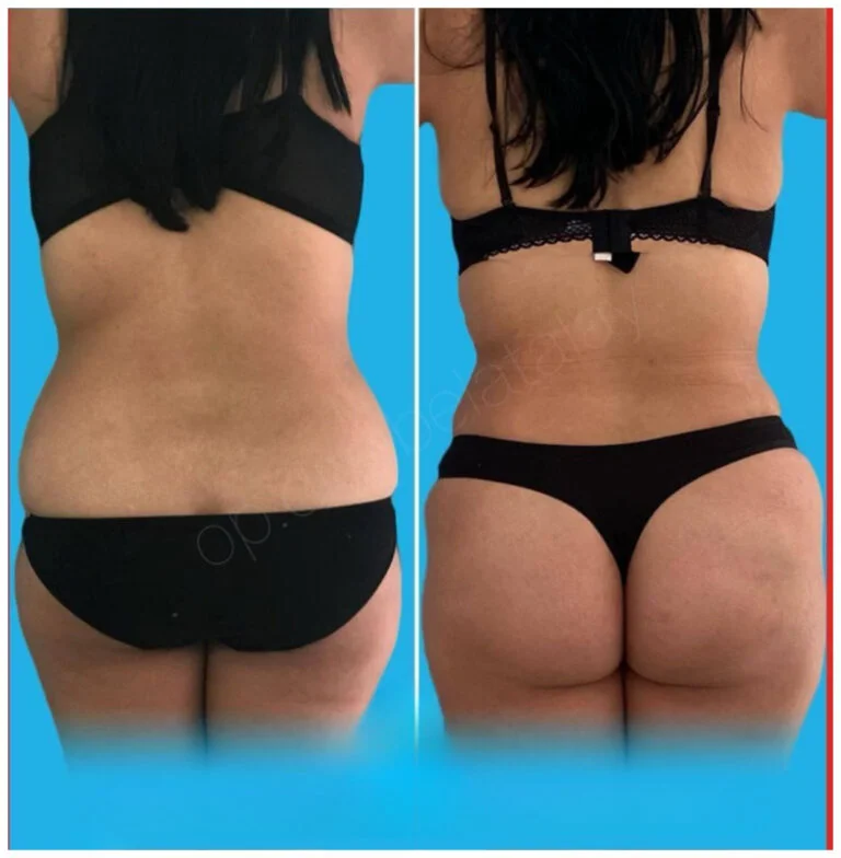Before and after comparison of a woman's back, highlighting changes in appearance, possibly after a cosmetic procedure or weight loss.