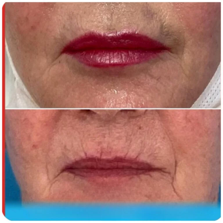 A before-and-after comparison of a person's lips, showcasing a noticeable enhancement in fullness and smoothness.