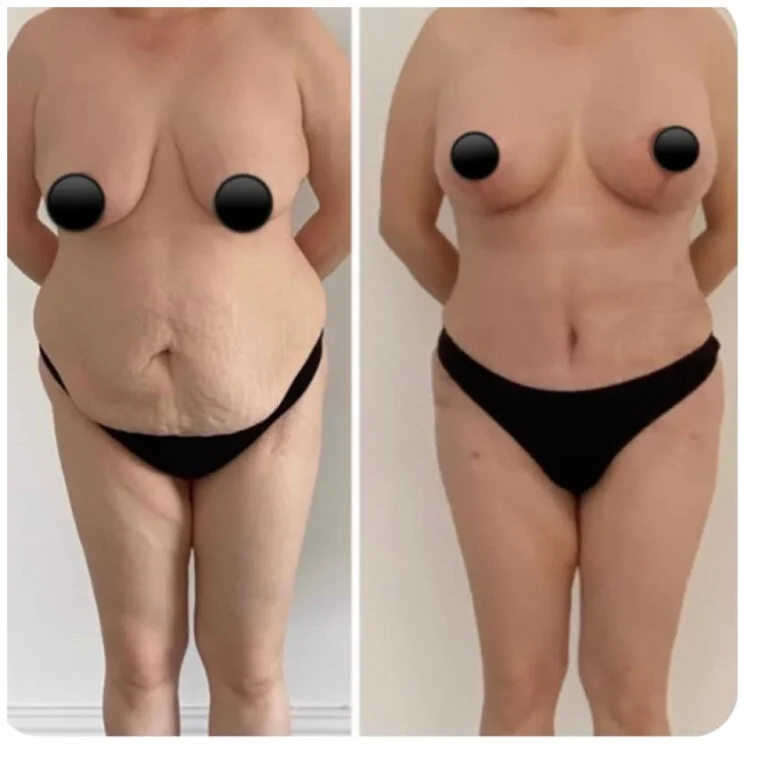 Before and after comparison of a woman's torso, highlighting the results of a tummy tuck procedure with noticeable reduction in abdominal fat and improved skin tightness.
