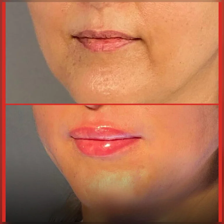 Before and after comparison of lip augmentation procedure showing the lips before and after the treatment.