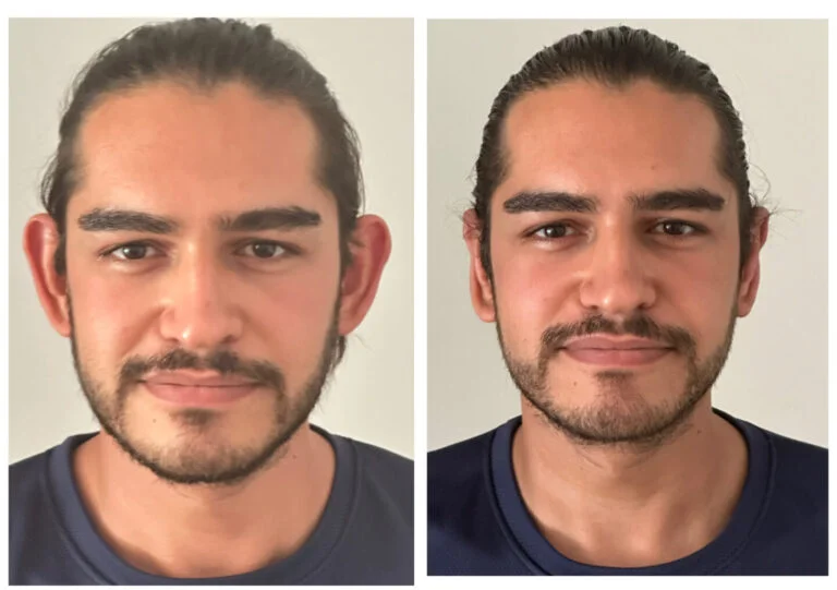 A before-and-after comparison of a man's face, showcasing changes in his facial features, likely due to a procedure or treatment. The man has short dark hair and a beard, and is wearing a dark blue shirt in both images.