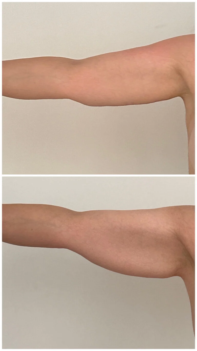 Before and after comparison of an arm showing results of a medical procedure, likely liposuction or fat reduction, highlighting the reduction in size and improved contour of the arm.