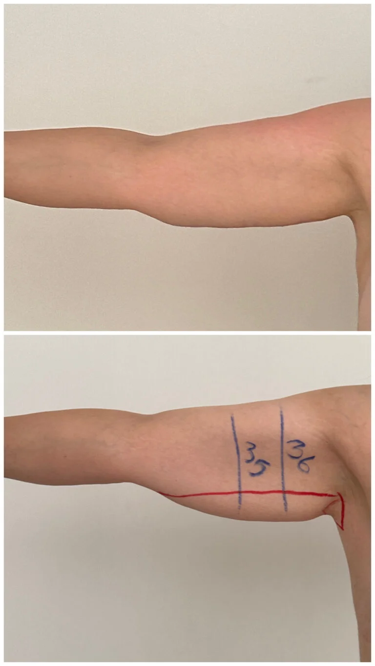A before-and-after comparison of a surgical procedure on an arm, showing measurements marked in centimeters.