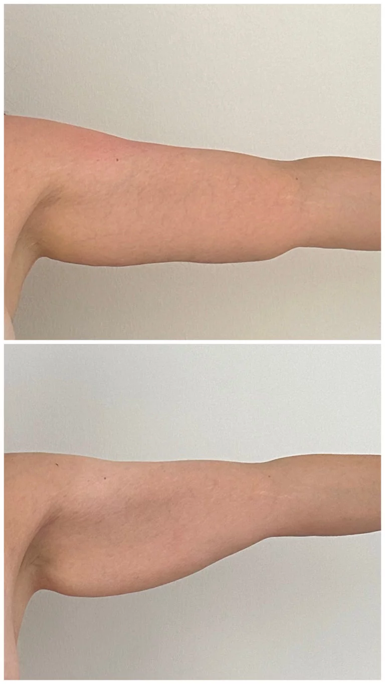 Two images of an arm showing before and after results of a medical procedure, likely surgery, against a plain background.